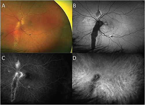 FIGURE 1: Fundus widefield photography taken with an Optos California of a 68-year-old patient’s left eye (A); fundus autofluorescence (B); fluorescein angiography (C); indocyanine green angiography (D). IMAGE COURTESY ALBERT LIN, MD