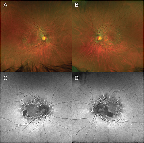 FIGURE 1: Color fundus photography showing retinal pigment epithelium (RPE) changes, with areas of RPE atrophy in the right (A) and left (B) eye in the macula and around the optic disc. Fundus autofluorescence imaging shows a granular pattern of hyper and hypoautofluorescence surrounding the macula and optic nerve with a characteristic radiating spoke pattern of hyperautofluorescence as well as patches of hypoautofluorescence characteristic of RPE atrophy in the right (C) and left (D) eye. Images taken with an Optos California imaging device. IMAGES COURTESY TIM TIVNAN, CRA. OPHTHALMIC PHOTOGRAPHER AT LAHEY HOSPITAL AND MEDICAL CENTER
