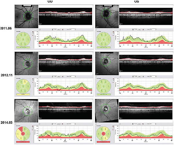 FIGURE 2. Retinal nerve fiber layer (RNFL) thickness map of a 46-year-old female being treated for seizures with 2,000 mg of vigabatrin per day. Over 33 months, imaging showed a bilateral decrease in RNFL thickness, with left RNFL loss greater than right. (Green corresponds to normal RNFL thickness, yellow borderline, and red below normal thickness.) Although the patient ended vigabatrin therapy at the end of this period, her vision did not improve. IMAGE ORIGINALLY PUBLISHED IN: BARRETT D, ET AL. VIGABATRIN RETINAL TOXICITY FIRST DETECTED WITH ELECTRORETINOGRAPHIC CHANGES: A CASE REPORT. J CLIN EXP OPHTHALMOL. 2014;5(5):1000363. DOI:10.4172/2155-9570.1000363. REPRINTED WITH PERMISSION UNDER HTTPS://CREATIVECOMMONS.ORG/LICENSES/BY/4.0/