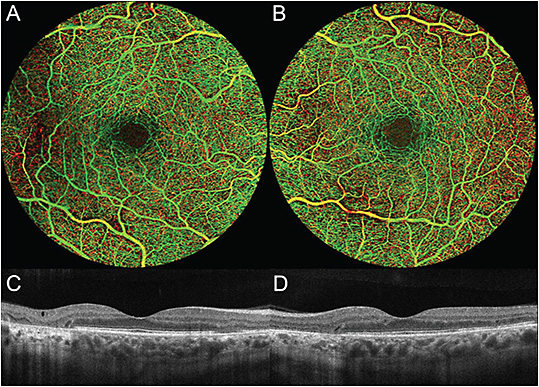 FIGURE 2: Optical coherence tomography (OCT) angiography of the right (A) and left (B) eye shows no signs of diabetic retinopathy but reveals mild changes, including decreased capillary density in areas of outer retinal atrophy, seen on structural OCT (C and D). Images taken with Cirrus (Carl Zeiss Meditec). IMAGES COURTESY TIM TIVNAN, CRA. OPHTHALMIC PHOTOGRAPHER AT LAHEY HOSPITAL AND MEDICAL CENTER