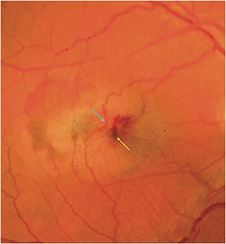 FIGURE 2. A color fundus photograph demonstrating neovascular macular telangiectasia type 2. The blue arrow indicates retinal-retinal anastomoses. The yellow arrow identifies a dilated aneurysm with hemorrhagic features. IMAGE COURTESY ZACK OAKEY, MD