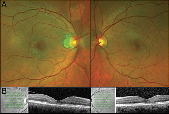 FIGURE 1. Color fundus photography showing pigmentary changes temporal to the fovea (A). There are ectatic capillaries and white-appearing crystalline deposits. OCT scanning (B) shows focal attenuation of the inner segment and outer segments of the juxtafoveal retina. IMAGE COURTESY ZACK OAKEY, MD