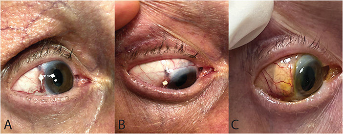 FIGURE 1. Preoperative photos (A, B) of the demarcated plaque with hyperpigmentation in the temporal border of the limbus adjacent to an exposed Gore-Tex suture in the right eye. (C) Postoperative photo of right eye after surgical exploration with conjunctival reconstruction and scleral patch graft. IMAGES COURTESY SARWAR ZAHID, MD