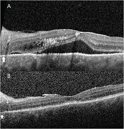 FIGURE 2: Heidelberg optical coherence tomography (OCT) of the left eye before surgery showing subretinal and intraretinal fluid (A) and two months after surgery (B) showing scleral windows. Arrow indicates temporal crescent with above intraretinal edema. IMAGE COURTESY ALBERT LIN, MD