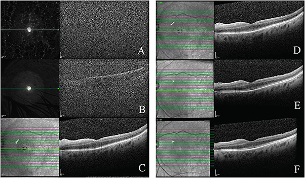 FIGURE 1: These optical coherence tomography (OCT) images, taken with a Heidelberg Spectralis, demonstrate the progressive improvement in the patient’s media clarity from postoperative day 1 (A) and postoperative day 11 (B) to successive follow-up visits (C-F). The striking retinal thinning and inner segment/outer segment (IS/OS) disruption that is most prominent in the temporal macula is noted in the first interpretable OCT on postoperative day 28 (C). There is small progressive improvement to the outer retinal layer integrity from postoperative day 42 (D) to day 70 (E), and finally to postoperative day 100 (F). The near infrared reflectance imaging, shown on the left panel of each subfigure, also illustrates the resolving ICG-staining of the internal limiting membrane, with staining almost completed resolved by postoperative day 100 (F). IMAGES COURTESY JAKE BREAZEALE AND ASGHAR HAIDER, MD