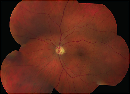 FIGURE 2: Montage fundus photograph of the left eye showing indocyanine green–stained internal limiting membrane on postoperative day 28. Images taken with a Topcon TRC-50DC Mydriatic Camera. IMAGE COURTESY JAKE BREAZEALE AND ASGHAR HAIDER, MD