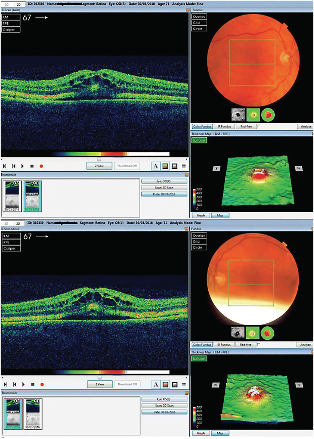 FIGURE 1. Optical coherence tomography (OCT) scan of a 71-year-old patient with melanoma, who had been treated for 4 months with trametinib, a MEK inhibitor. The imaging revealed intraretinal and subretinal fluid on macula with cystoid changes in the perifoveal area in both eyes, with significant thickening of the ellipsoid zone and subretinal granular deposits overlying an apparently intact retinal pigment epithelium (RPE). After cessation of trametinib, the cystoid macular edema resolved over a 6-month period. IMAGE ORIGINALLY PUBLISHED IN: TYAGI P, SANTIAGO C. NEW FEATURES IN MEK RETINOPATHY. BMC OPHTHALMOL. 2018;18(SUPPL 1):221. DOI:10.1186/S12886-018-0861-8. REPRINTED WITH PERMISSION UNDER HTTPS://CREATIVECOMMONS.ORG/LICENSES/BY/4.0/